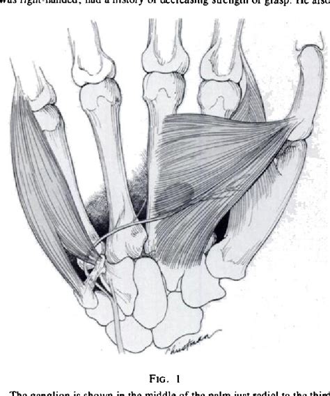 Figure 1 From Compression Of The Ulnar Nerve In The Hand By A Ganglion