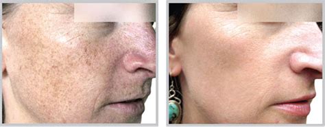 Phototherapy I Bbl Laser Treatment Of Age Spots Freckles Birth