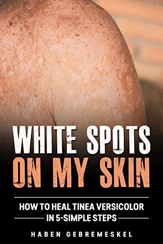 White Spots On My Skin How To Heal Tinea Versicolor In 5 Simple Steps