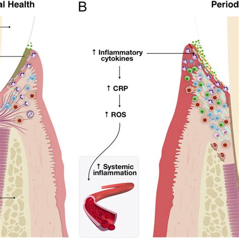 Periodontal Health And Immune Response In Periodontitis Schematics Of Download Scientific