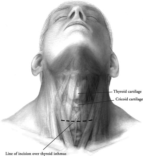 Conventional Thyroidectomy Operative Techniques In Otolaryngology
