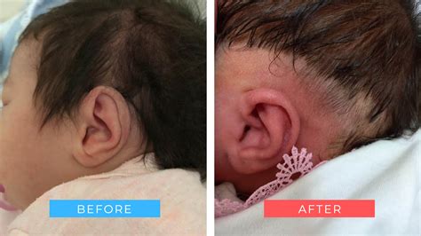 Baby Ear Correction Gallery Before After Examples Dr Onganlar