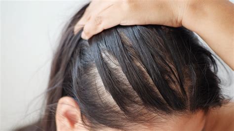 Top Image Sudden Hair Loss In Women Thptnganamst Edu Vn