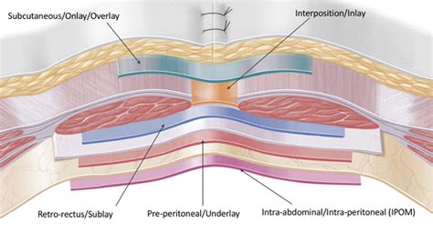 Pdf Nomenclature In Abdominal Wall Hernias Is It Time For Consensus