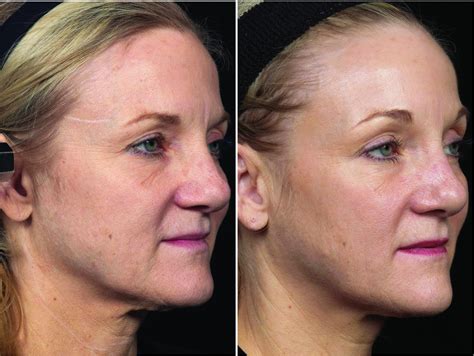 Thermage Before And After Photos Patient 34 Houston Tx Dermsurgery