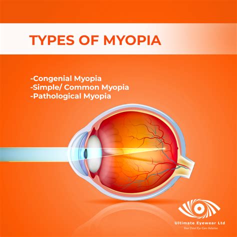 What You Need To Know About Myopia