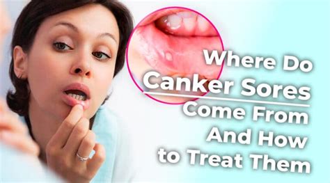 Where Do Canker Sores Come From And How To Treat Them