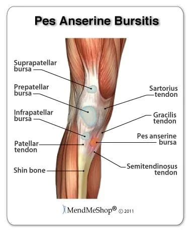 Pes Anserine Bursitis Knee Bursitis Treatment Sheboygan Wi The Best Porn Website