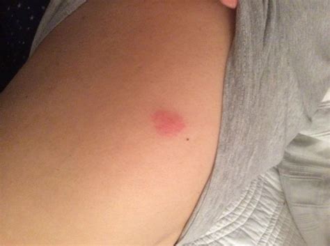 The centre of los angeles is 7 km from the accommodation. Bedbug bite on back - Picture of Hollywood City Inn, Los ...