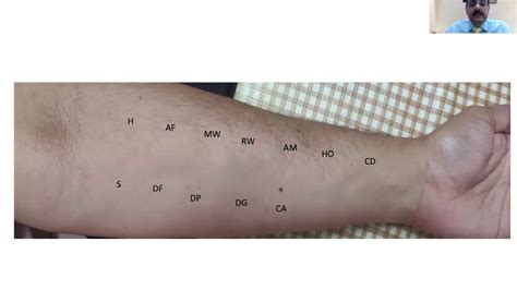 Skin Prick Test Or Spt Allergy Tests How Theyre Performed I Dr