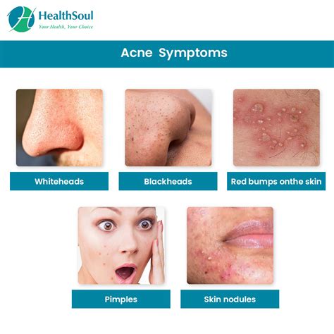 What R Symptoms Of Acne Acne Symptoms