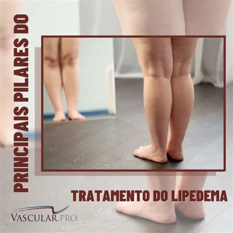 O Tratamento Do Lipedema Deve Ser Individualizado E Pensado De Acordo