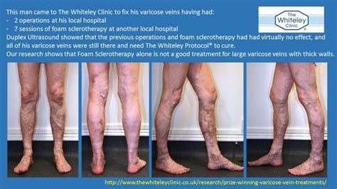 Foam Sclerotherapy Failure In Large Varicose Veins The Whiteley Clinic