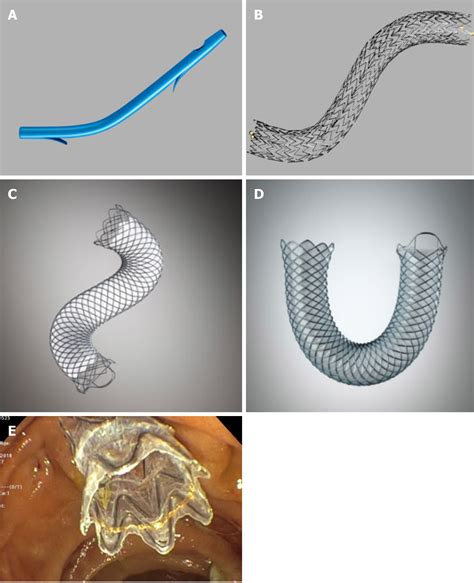 Fully Covered Metal Biliary Stents A Review Of The Literature