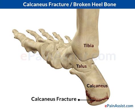 Calcaneus Calcaneus Fracture Or Broken Heel Types Causes Symptoms Diagnosis