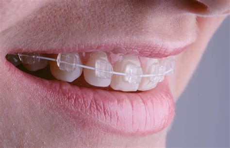 Ce Qu Il Faut Savoir Pour Obtenir Un Appareil Dentaire Après 50 Ans Ricape Update