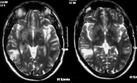 Cranial Mri Showing A High T2 Signal In The Brain Subcortical Area And