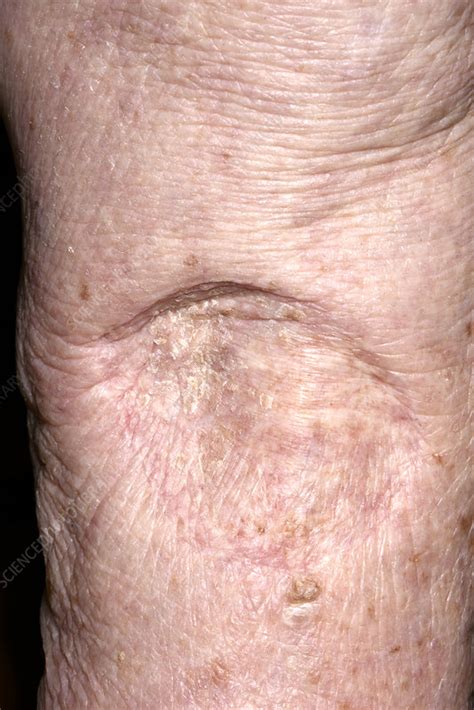 Scar After Skin Cancer Removal Stock Image C0284514 Science