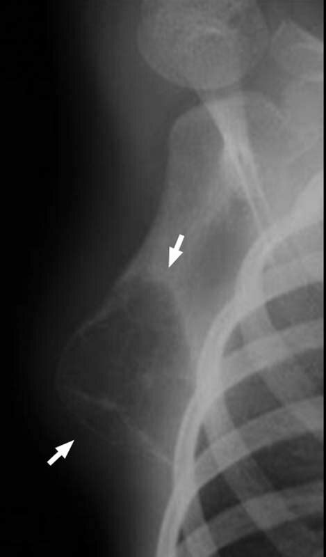 6 Year Old Girl Radiograph Of The Right Scapula In Ap Views With An