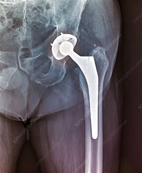 Total Hip Replacement X Ray Stock Image C0480719 Science Photo