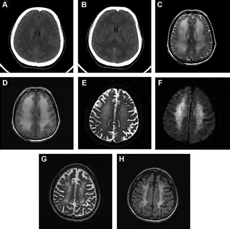 Images Of Delayed Postanoxic Encephalopathy Notes A And B Brain Ct