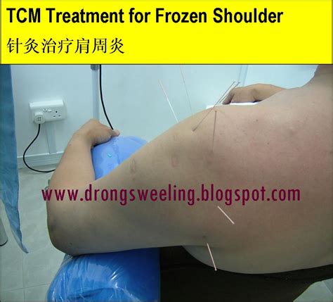 Tcm News Tcm Clinic Tcm Physician Frozen Shoulder Healed