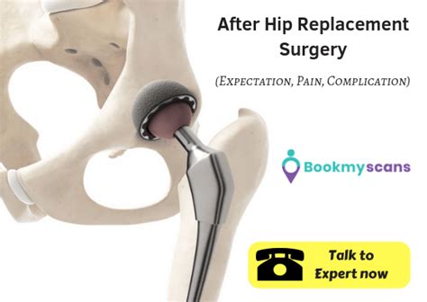 After Hip Replacement Surgery Expectation Pain And Complications