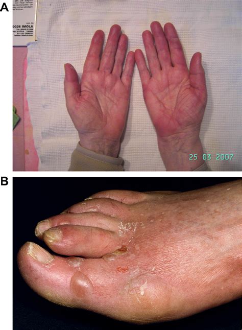 Pegylated Liposomal Doxorubicin Associated Handfoot Syndrome