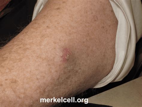 Clinical Photos Of Merkel Cell Carcinoma Merkel Cell Carcinoma