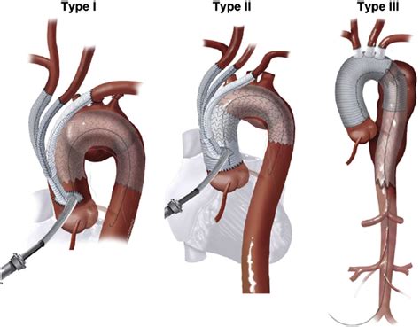 Association Between Aortic Remodeling And Stent Graft Induced New Entry In Extensive Residual