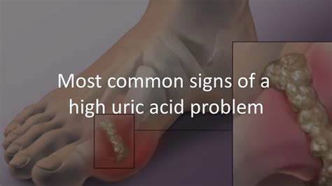 Signs And Symptoms Of High Uric Acid Level In A Body Youtube