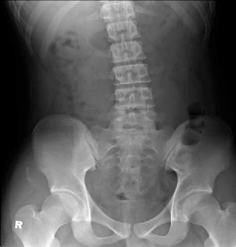 Figure 1 From Anterior Inferior Iliac Spine Avulsion Fracture In An