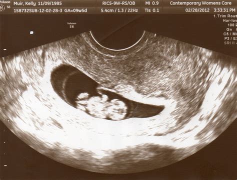 Little Baby Muir 8 Week Sonogram