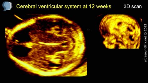 Fetal Brain At 12 Weeks Cerebral Ventricles 3d Ultrasound Youtube