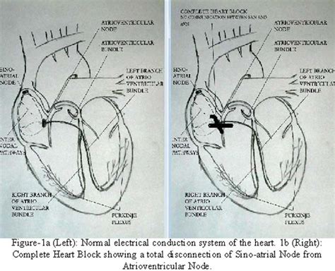 It also contains a computer that tracks your heart rate and rhythm. Dual Chamber Pacemaker Implants — A new opportunity in ...