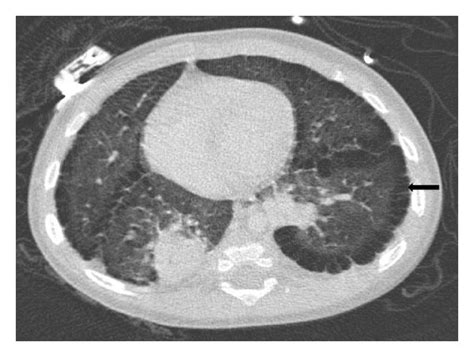 Axial View Of Chest Ct Shows The Subpleural Cysts Block Arrow Of Both