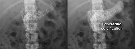 Abdominal X Ray Gallery Calcification Pancreatic Calcification