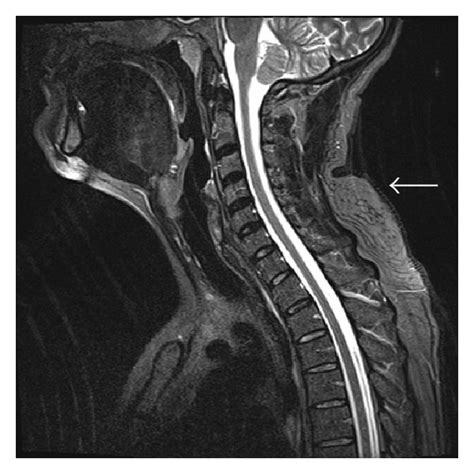 Mri Of The Neck Demonstrates A Subcutaneous Mass White Arrows In The