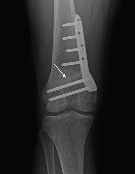 Medial Closing Wedge Distal Femoral Osteotomy For Genu Valgum With