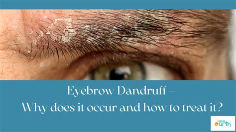 Eyebrow Dandruff Why Does It Occur And How To Treat It