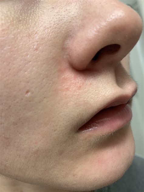 Possible Irritation Rash Under Nose From Tret Or From Something Else