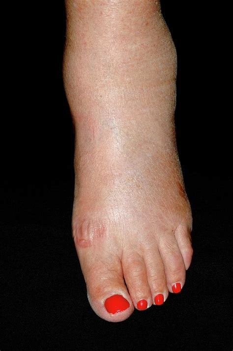 Ankle Swelling After Amlodipine Drug Photograph By Dr P Marazzi My