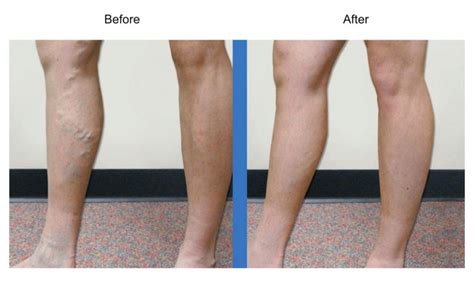 What To Expect From Sclerotherapy Vein Specialists Of The Carolinas