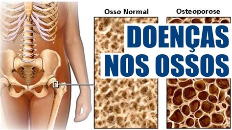 Doencas Do Sistema Esqueletico
