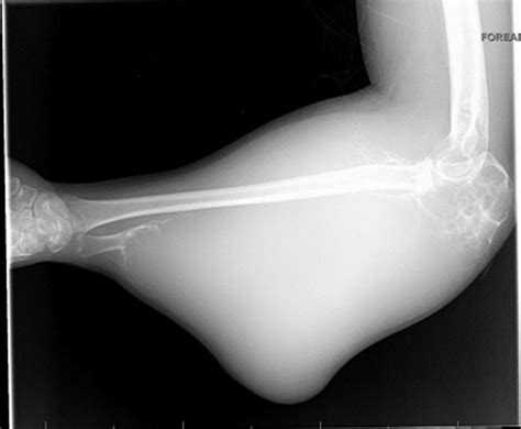 A 29 Year Old Man With Pain And Swelling Of The Elbows Jbjs Image Quiz