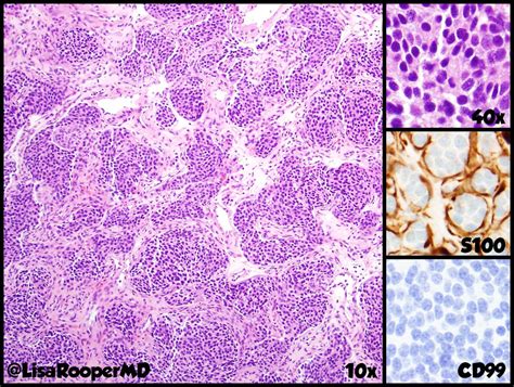Olfactory Neuroblastoma Pathology Morphology And Grepmed