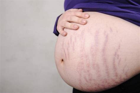 how can you reduce stretch marks during pregnancy