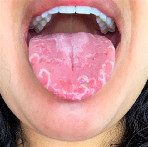 White Spots On Tongue White Spots On Tongue Bumps Pat