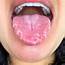 My Geographic Tongue During Allergy Season  Mildlyinteresting