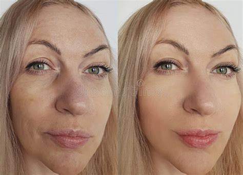 Woman Face Wrinkles Removal Lift Correction Before And After Treatment